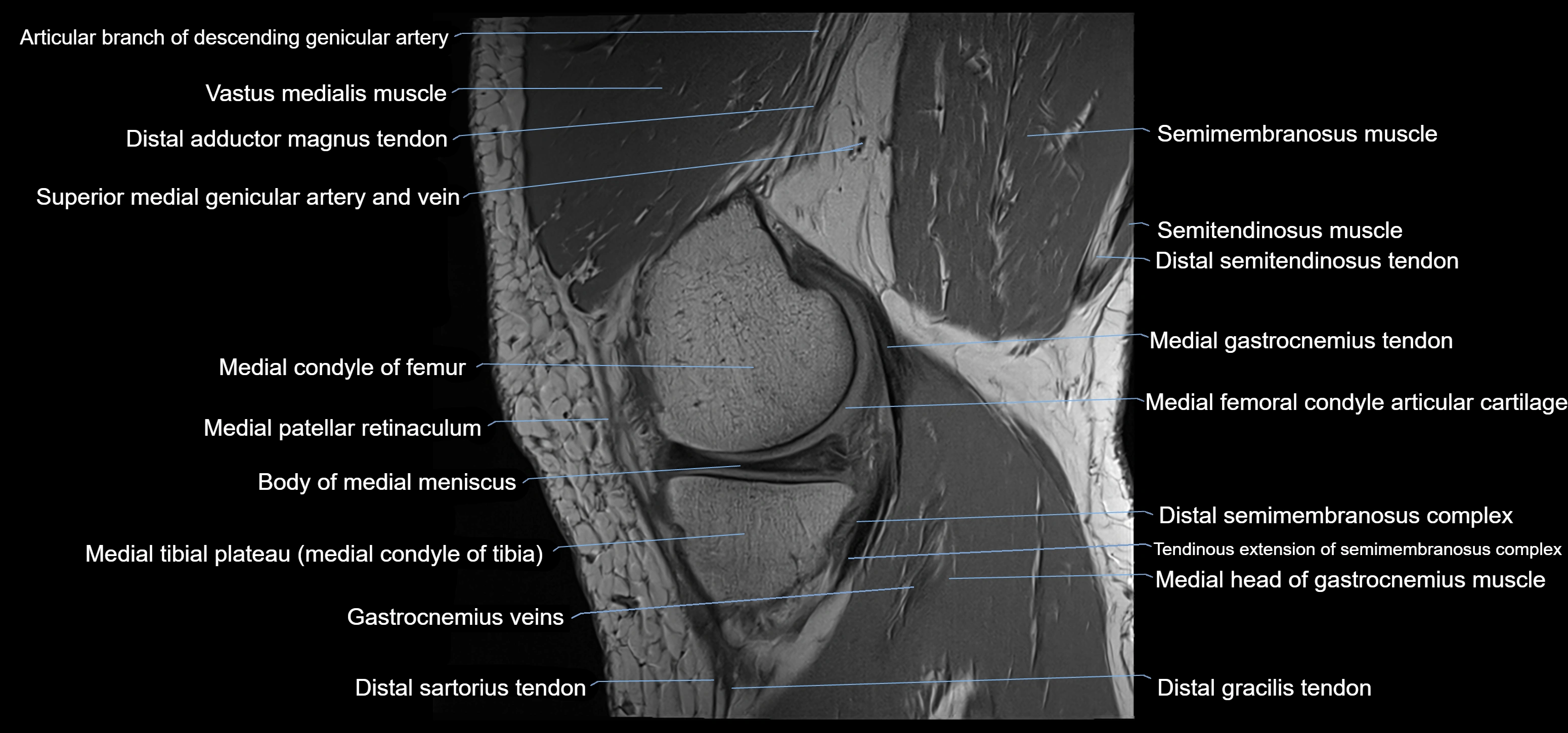 MRI knee sagittal cross sectional anatomy labelled 3T radiology image-00013.webp
